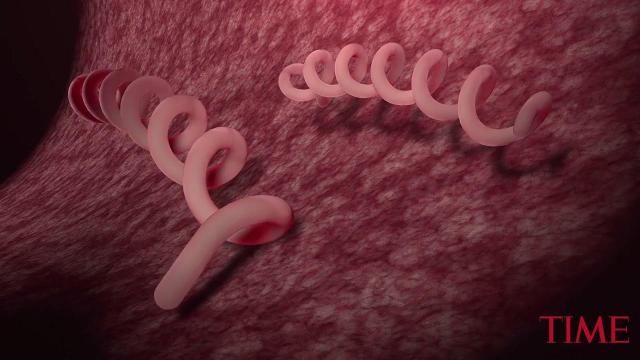 Syphilis cases in California drive a record-setting year for STDs nationwide - Desert Sun