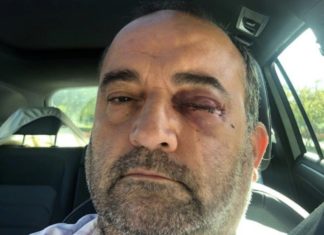 Man knocked unconscious & could lose sight in vicious anti-gay hate attack – LGBTQ Nation
