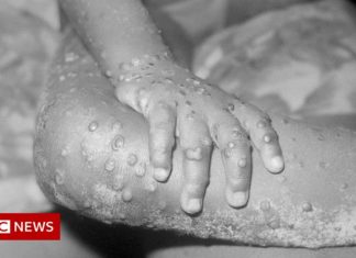 Monkeypox: Expert teams set up on both sides of Irish border – BBC