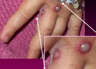 Why experts think the monkeypox outbreak can be contained – Vox.com