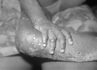 Belgium becomes first country to introduce mandatory monkeypox quarantine as global cases rise – CNBC