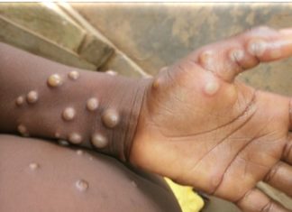 Britain now has more than 300 cases of monkeypox, health officials say – UPI News