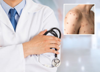 Gay Doctor Shares Monkeypox Experience: ‘I Was in Disbelief’ – Newsweek