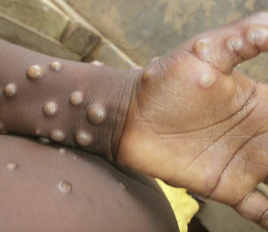 Health Experts Warn of Monkeypox Infections Among Gay Men – Metro Weekly