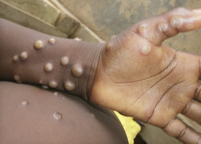 Health Experts Warn of Monkeypox Infections Among Gay Men - Metro Weekly
