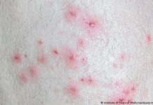 Monkeypox: How to protect yourself against the virus – DW (English)