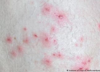 Monkeypox: How to protect yourself against the virus – DW (English)