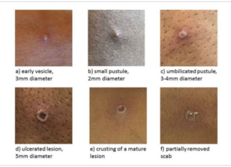 Monkeypox is spreading among gay men worldwide – aidsmap