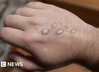 Monkeypox outbreak mostly in young men in London – BBC