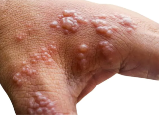 Monkeypox spreading among gay men, county says – WEHOville