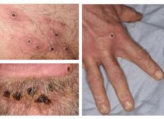 Toronto Public Health hosts 2 clinics to vaccinate against monkeypox – CBC.ca
