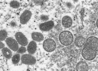 UK: 77 new monkeypox cases, biggest outbreak outside Africa – The Associated Press – en Español