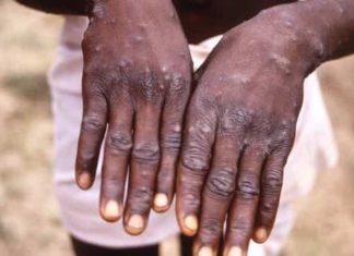 World Health Network declares Monkeypox a pandemic | Mint – Mint