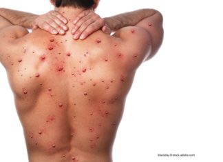 World Health Network Declares Monkeypox Outbreak a Pandemic – Drug Topics