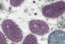 Louisville health officials monitoring three monkeypox cases – 89.3 WFPL News Louisville