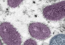 Louisville health officials monitoring three monkeypox cases – WKU Public Radio