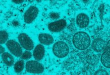 Monkeypox is not a ‘gay disease.’ Experts say stigmatizing it is bad for public health. – Grid