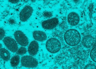 Monkeypox is not a ‘gay disease.’ Experts say stigmatizing it is bad for public health. – Grid