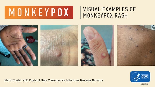 Monkeypox reported in Buncombe County, free vaccines available - Citizen Times