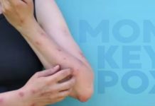 Monkeypox vaccine now available to more people – WEHOville