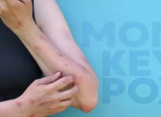 Monkeypox vaccine now available to more people – WEHOville
