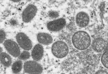 Monkeypox: WHO reports 5,322 lab-confirmed cases in 53 countries – The Statesman