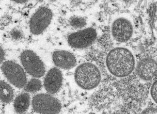 Monkeypox: WHO reports 5,322 lab-confirmed cases in 53 countries – The Statesman
