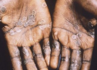 S.C. sees first monkeypox patients, while Ga. cases keep rising – WRDW