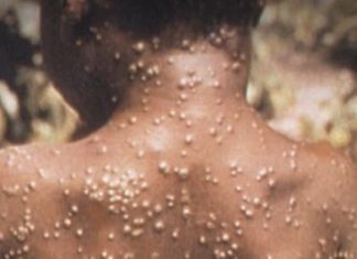 Suffolk to announce monkeypox vaccine rollout; Nassau confirms county’s first case – News 12 New Jersey