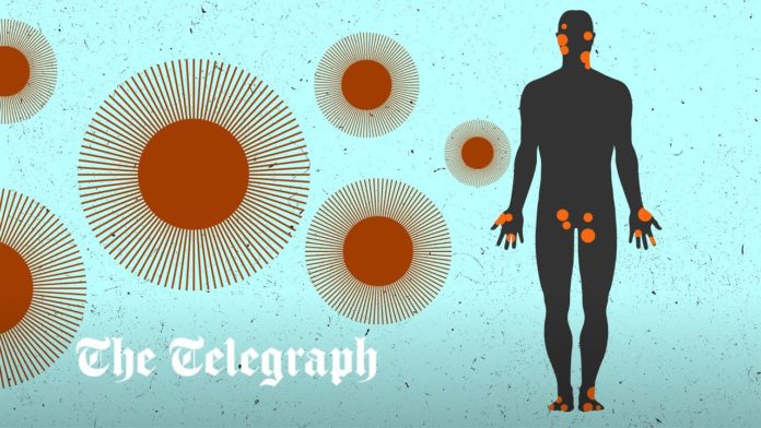 UK monkeypox vaccine rollout 'too slow' as cases surpass 1700 - The Telegraph