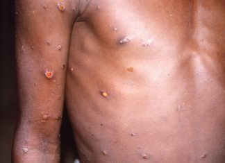WATCH | SA monkeypox case trends as ‘men who have sex with men’ sparks stigmatisation concerns – TimesLIVE
