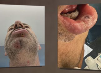 98% of monkeypox cases among gay men, health officials warn spread possible for everyone – WTVG
