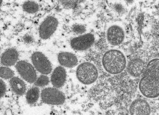 African monkeypox cases not concentrated among gay men, experts say – Rappler