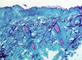 CDC officials sound alarm for gay, bisexual men as monkeypox spreads – CNBC