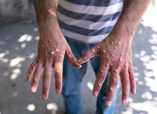 Could Only Think About Pain: Patients Narrate Monkeypox Experience – NDTV
