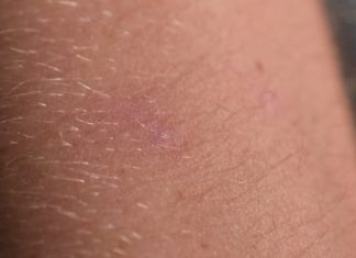 LGBTQ advocacy group wants more monkeypox info, pop-up vaccine clinics – CBC.ca