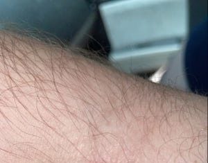 Louisville resident shares monkeypox journey to help decrease stigma – Courier Journal