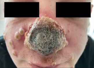 Monkeypox And The Face Of Gay Promiscuity – The American Conservative
