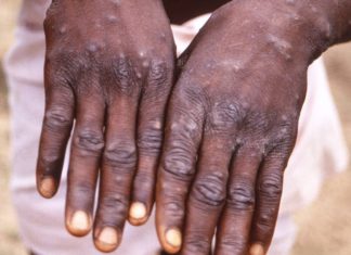 Monkeypox cases in NC more prevalent in gay, African American men – WECT