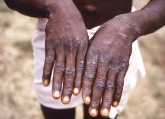 Monkeypox: Colleges, universities prepare for return of students amid health emergency – MassLive.com