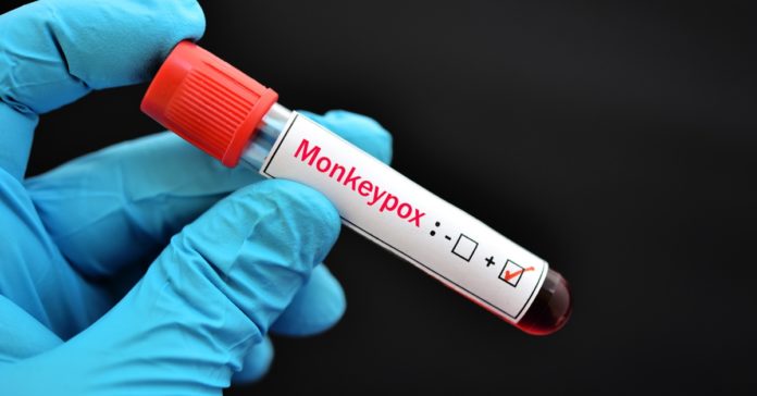 Monkeypox Outbreak: Testing, Vaccines, and More | Johns Hopkins | Bloomberg School of Public Health - Johns Hopkins Bloomberg School of Public Health