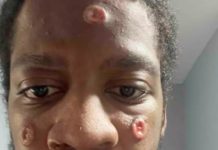 Monkeypox shows disparity in Black gay and bisexual men – The Black Wall Street Times