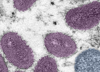 St. Louis health officials answer your questions about the monkeypox outbreak – St. Louis Public Radio