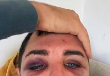 Sydney man shares horrific injuries from gay hate crime in Oxford St, Darlinghurst – Daily Mail