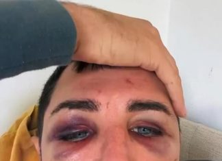 Sydney man shares horrific injuries from gay hate crime in Oxford St, Darlinghurst – Daily Mail