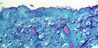 Texas reports what may be the first U.S. death from monkeypox – CNBC