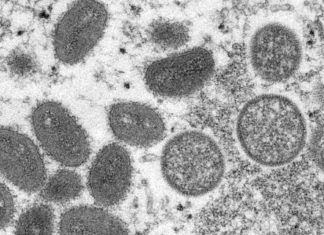 Though gay men are most at risk, health experts warn not to think of monkeypox as ‘gay disease’ – WBFO