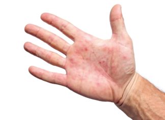 Virus Expert Just Issued This “Essential” Monkeypox Update — Eat This Not That – Eat This, Not That
