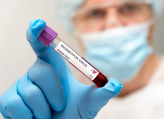 What Coloradans Need to Know About Monkeypox – 5280 – 5280 | The Denver Magazine