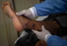 WHO: Global monkeypox cases drop 21%, reversing month-long increase | Mint – Mint
